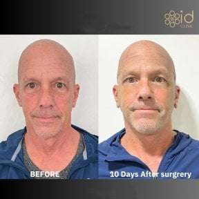 Before and after brow lift results at ID Clinic Bangkok, visible forehead and eye area improvement