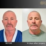 Before and after brow lift results at ID Clinic Bangkok, visible forehead rejuvenation