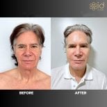 Before and after brow lift results at ID Clinic Bangkok, visible forehead and eye area rejuvenation