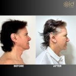 Before and after brow lift results at ID Clinic Bangkok, visible forehead and eye area lift