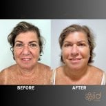 Before and after endoscopic facelift results at ID Clinic Bangkok, facial rejuvenation visible
