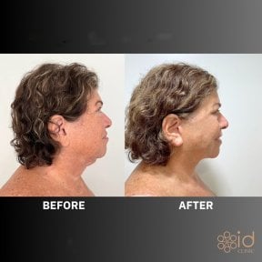 Before and after endoscopic facelift results at ID Clinic Bangkok, visible facial rejuvenation