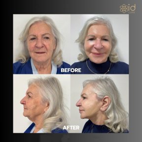 Facelift before and after results at ID Clinic Bangkok, visible facial rejuvenation and lift