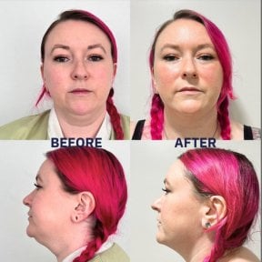 Before and after neck liposuction results at ID Clinic Bangkok, visible jawline contouring