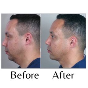 Before and after chin liposuction results at ID Clinic Bangkok, improved jawline contour