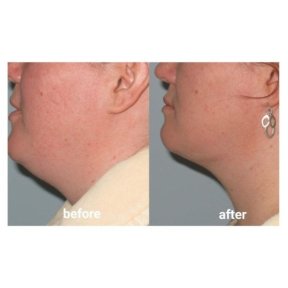 Before and after chin liposuction results at ID Clinic Bangkok, improved jawline contour