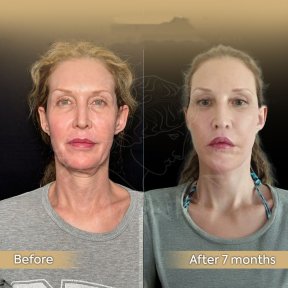 Vorher-nachher-Ergebnis Brauenlifting bei Dr. Safa Manav Clinic, sichtbare Stirnanhebung nach 7 Monaten