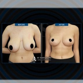 Before and after breast lift with implants results at Dr. Safa Manav Clinic, improved contour