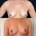 Before and after breast lift with round implants at Dr. Safa Manav Clinic, enhanced contour result