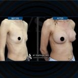 Before and after breast lift with implants round result at Dr. Safa Manav Clinic