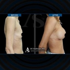 Before and after breast lift with round implants results at Dr. Safa Manav Clinic