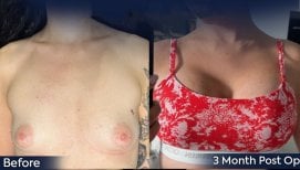 Przed i po liftingu piersi z okrągłymi implantami w Dr. Safa Manav Clinic, 3 miesiące