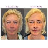 Vorher-nachher-Ergebnis Deep Plane Facelift bei Db'est Clinic, sichtbare Verjüngung