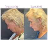 Vorher-nachher-Ergebnis Deep Plane Facelift bei Db'est Clinic, sichtbare Verjüngung