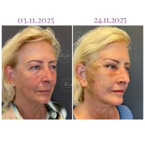 Vorher-nachher-Ergebnis Deep Plane Facelift bei Db'est Clinic, sichtbare Verjüngung