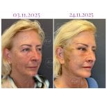 Vorher-nachher-Ergebnis Deep Plane Facelift bei Db'est Clinic, sichtbare Verjüngung