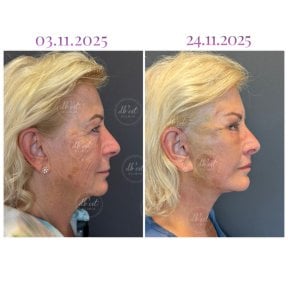 Vorher-nachher-Ergebnis Deep Plane Facelift bei Db'est Clinic, sichtbare Verjüngung