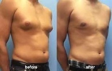 Before and after Vaser liposuction results at ID Clinic Bangkok, improved male body contour