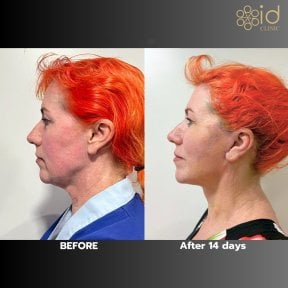 Facelift before and after results at ID Clinic Bangkok, visible facial rejuvenation after 14 days