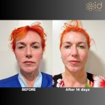 Facelift before and after results at ID Clinic Bangkok, visible facial rejuvenation after 14 days