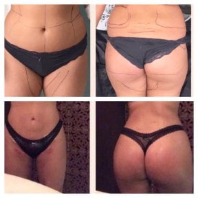 Результаты до и после Brazilian Butt Lift в Istanbul Aesthetic Plastic Surgery Center