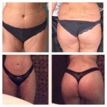 Результаты до и после Brazilian Butt Lift в Istanbul Aesthetic Plastic Surgery Center