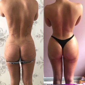 Результаты до и после Brazilian Butt Lift в Istanbul Aesthetic Plastic Surgery Center