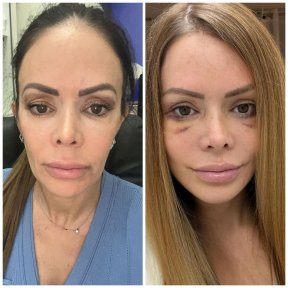 Vorher-nachher-Ergebnisse der Nasenkorrektur im Istanbul Aesthetic Plastic Surgery Center