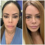 Vorher-nachher-Ergebnisse der Nasenkorrektur im Istanbul Aesthetic Plastic Surgery Center