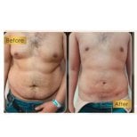 Before and after Vaser liposuction results at ID Clinic Bangkok, visible abdominal contouring