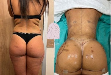 Before and after liposuction results at Dr. MED, visible waist and buttock contour improvement