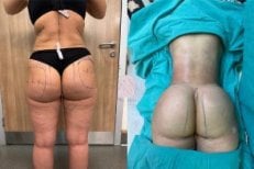 Before and after liposuction results at Dr. MED, visible body contouring and fat removal