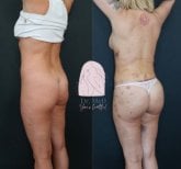 Before and after liposuction results at Dr. MED, visible body contouring and fat reduction