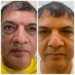 Before and after stem cell rejuvenation therapy results at ID Clinic Bangkok for anti-aging