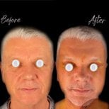 Facelift before and after results at Dr. MED – visible facial rejuvenation and tighter skin