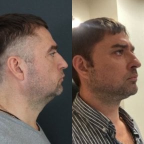 Facelift before and after results at Dr. MED – improved jawline and neck contour in male patient
