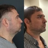 Facelift before and after results at Dr. MED – improved jawline and neck contour in male patient