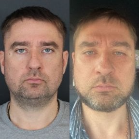 Facelift before and after results at Dr. MED, visible facial rejuvenation and contouring