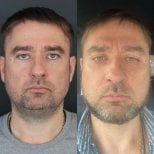 Facelift before and after results at Dr. MED, visible facial rejuvenation and contouring