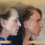 Brow Lift Vorher-Nachher-Ergebnis bei Dr. Safa Manav Clinic, sichtbare Stirnstraffung