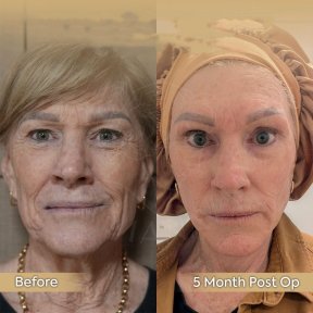 Brow Lift Vorher-Nachher-Ergebnis in der Dr. Safa Manav Klinik, 5 Monate postoperativ