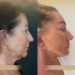 Vorher-nachher-Ergebnis Brauenlifting bei Dr. Safa Manav Clinic, sichtbare Verjüngung