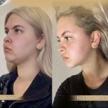 Vorher-nachher-Ergebnis Kinnliposuktion bei Dr. Safa Manav Clinic, verbesserte Kinnlinie