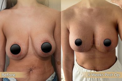 Vorher-nachher-Ergebnis Brustverkleinerung bei Dr. Safa Manav Clinic, verbesserte Form