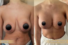 Vorher-nachher-Ergebnis Brustverkleinerung bei Dr. Safa Manav Clinic, verbesserte Form