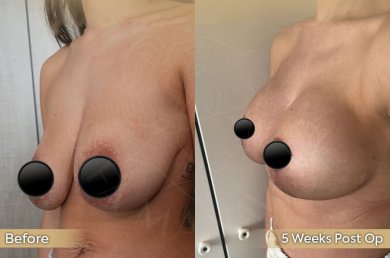 Vorher-nachher-Ergebnis Brustverkleinerung bei Dr. Safa Manav Clinic, 5 Wochen post-op