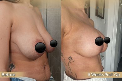 Vorher-nachher-Ergebnis Brustverkleinerung bei Dr. Safa Manav Clinic, 5 Wochen post-op