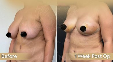 Vorher-nachher-Ergebnis Brustverkleinerung bei Dr. Safa Manav Clinic, 1 Woche post-op