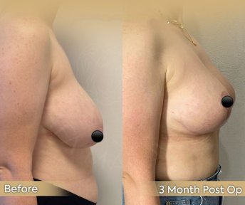 Vorher-nachher-Ergebnis Brustverkleinerung in der Dr. Safa Manav Klinik, 3 Monate post-op
