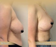 Vorher-nachher-Ergebnis Brustverkleinerung in der Dr. Safa Manav Klinik, 3 Monate post-op